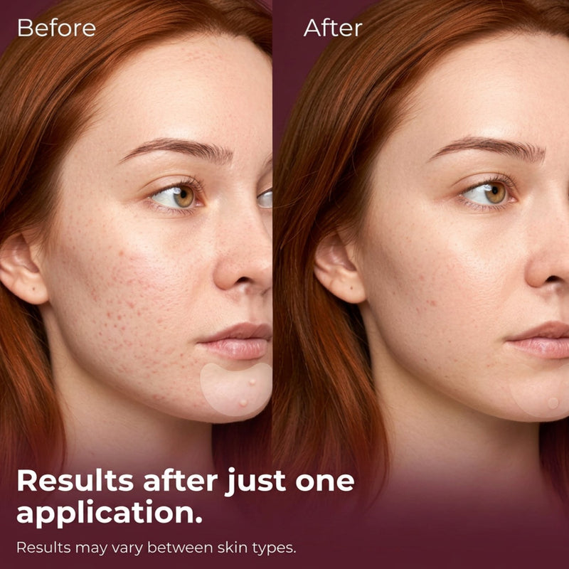 Patches and Pads Pimple Patches Undercover
