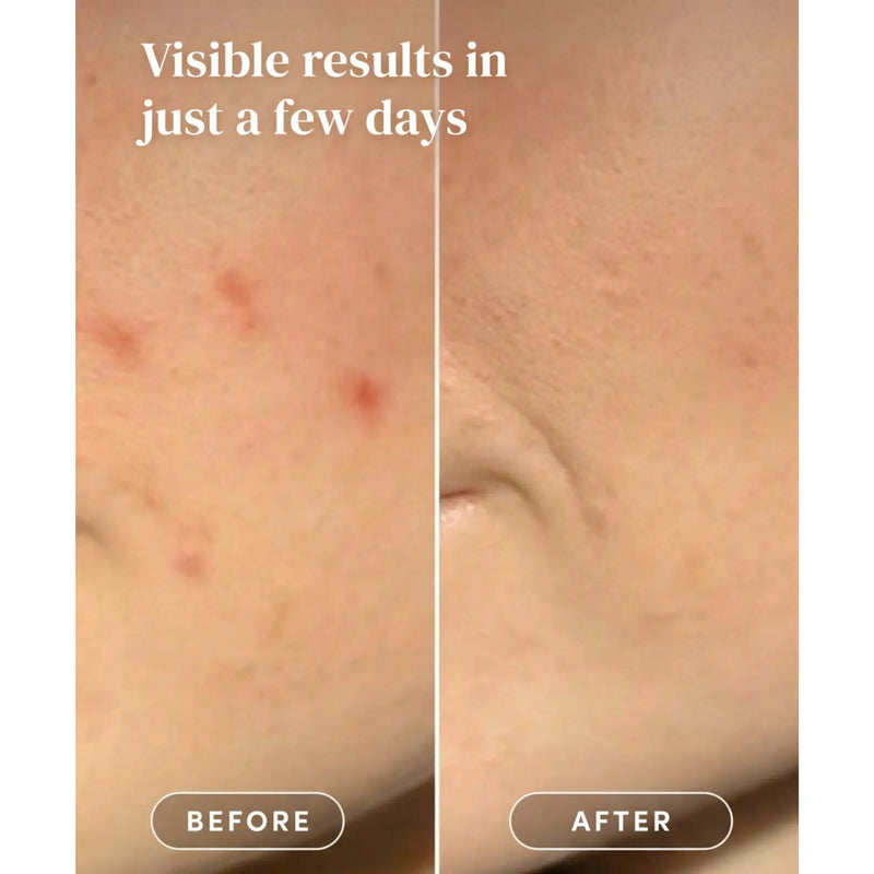 Apricot Beauty Post Pimple Patches